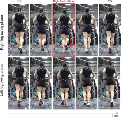 Symptom Locus and Symptom Origin Incongruity in Runner’s Dystonia – Case Study of an Elite Female Runner